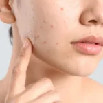 Best Sunscreen for Oily Acne-Prone Skin