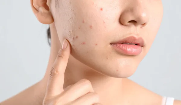 Best Sunscreen for Oily Acne-Prone Skin